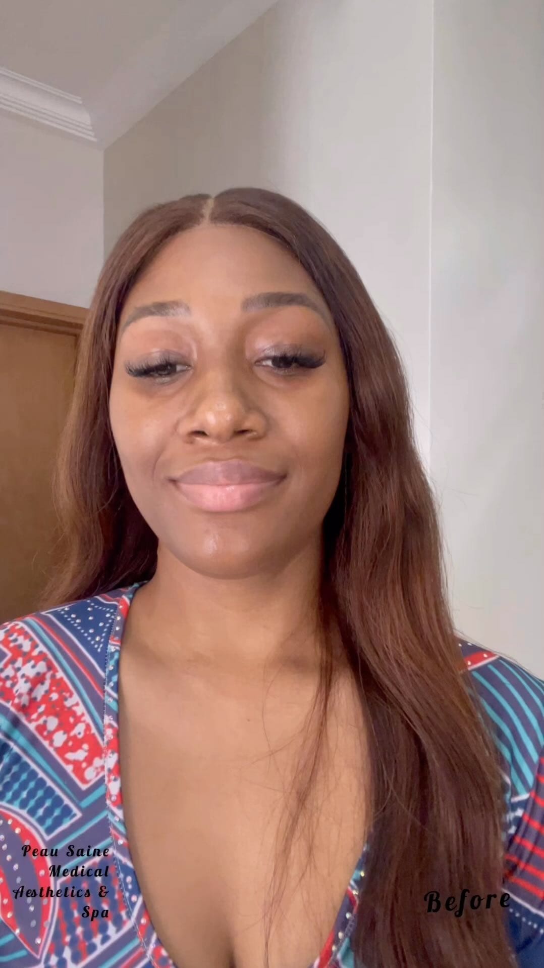 Post 8 by PEAU SAINE MEDICAL AESTHETICS🇨🇦 🇳🇬 on Instagram (video)