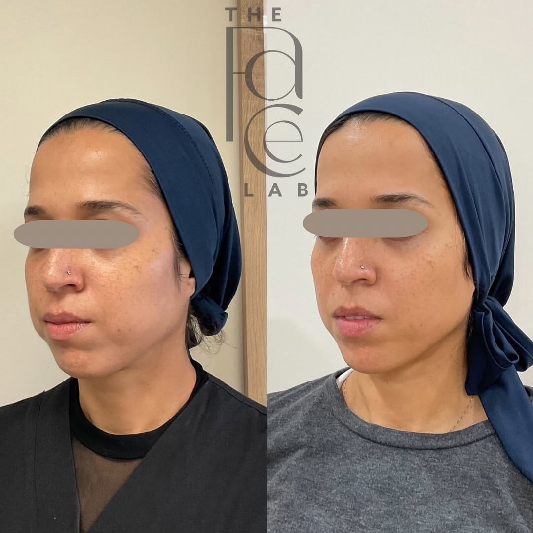 Post 4 by Aerolase | PRFM | Tixel | Sofwave | Facial Balancing on Instagram (carousel)