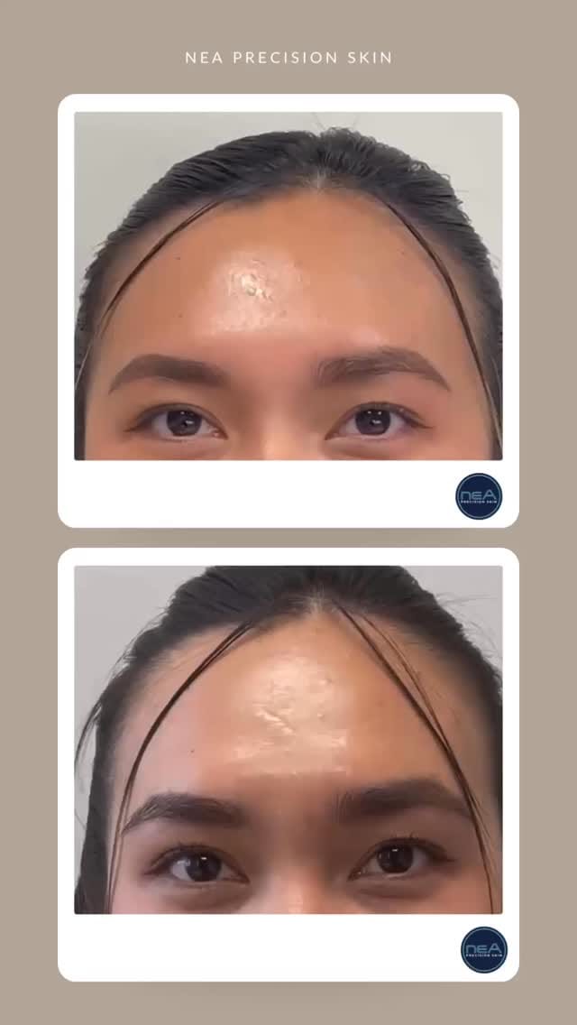 Post 6 by NEA Precision Skin on Instagram (video)