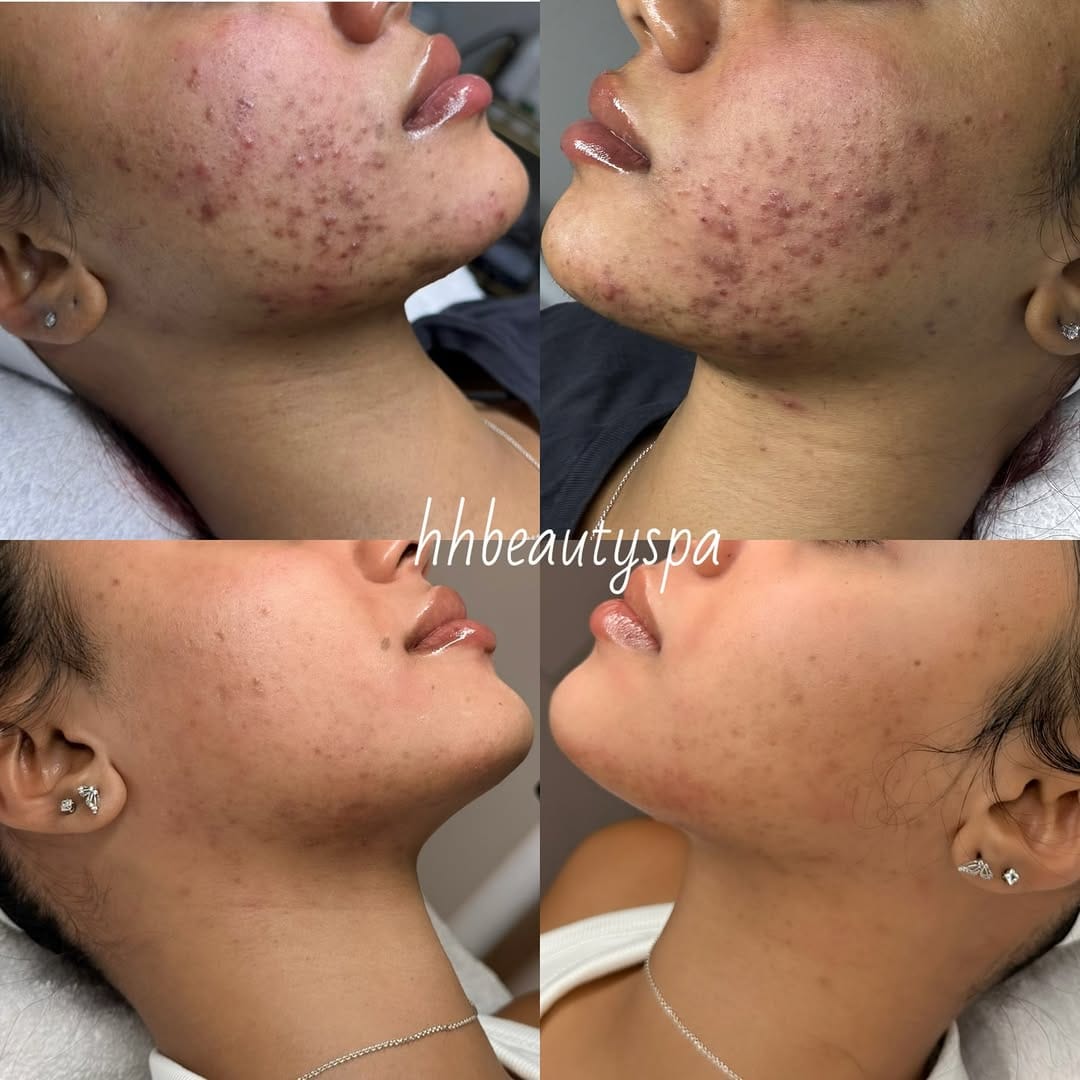 Post 8 by Adebimpe Akindele | hhbeautyspa | Acne & Skin Specialist on Instagram (image)