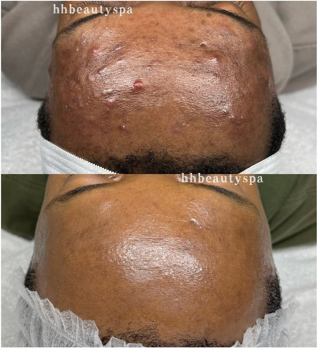 Post 10 by Adebimpe Akindele | hhbeautyspa | Acne & Skin Specialist on Instagram (image)