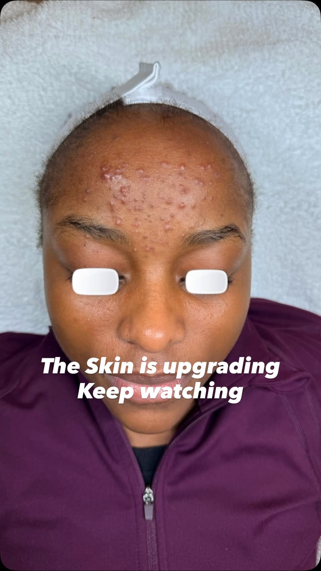 Post 3 by Adebimpe Akindele | hhbeautyspa | Acne & Skin Specialist on Instagram (video)