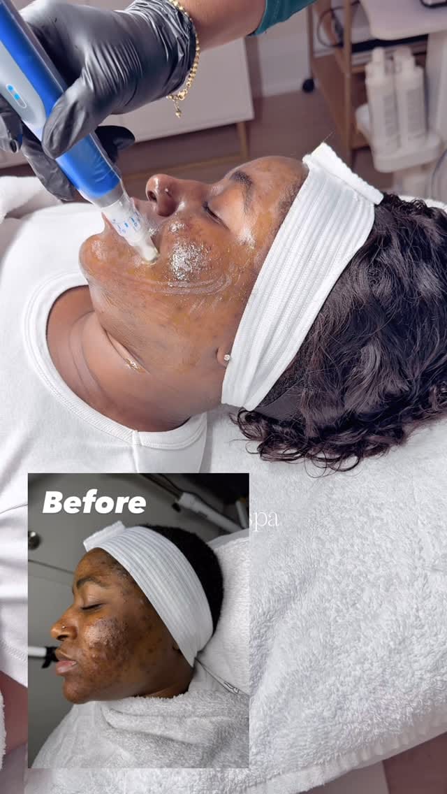 Post 4 by Adebimpe Akindele | hhbeautyspa | Acne & Skin Specialist on Instagram (video)
