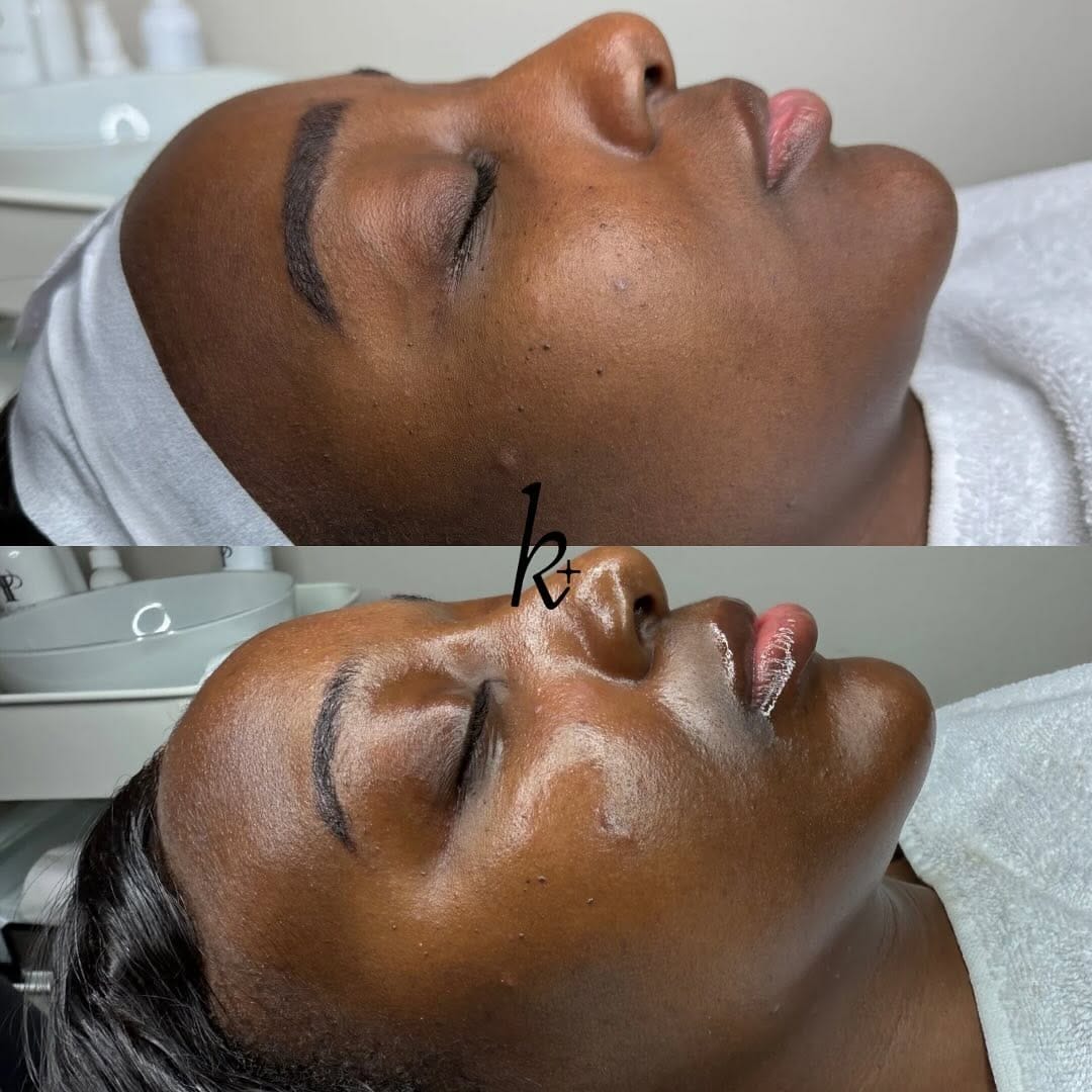 Post 10 by GTA CORRECTIVE SKIN SPECIALIST | HYDRAFACIAL PEELS MICRONEEDLING on Instagram (carousel)