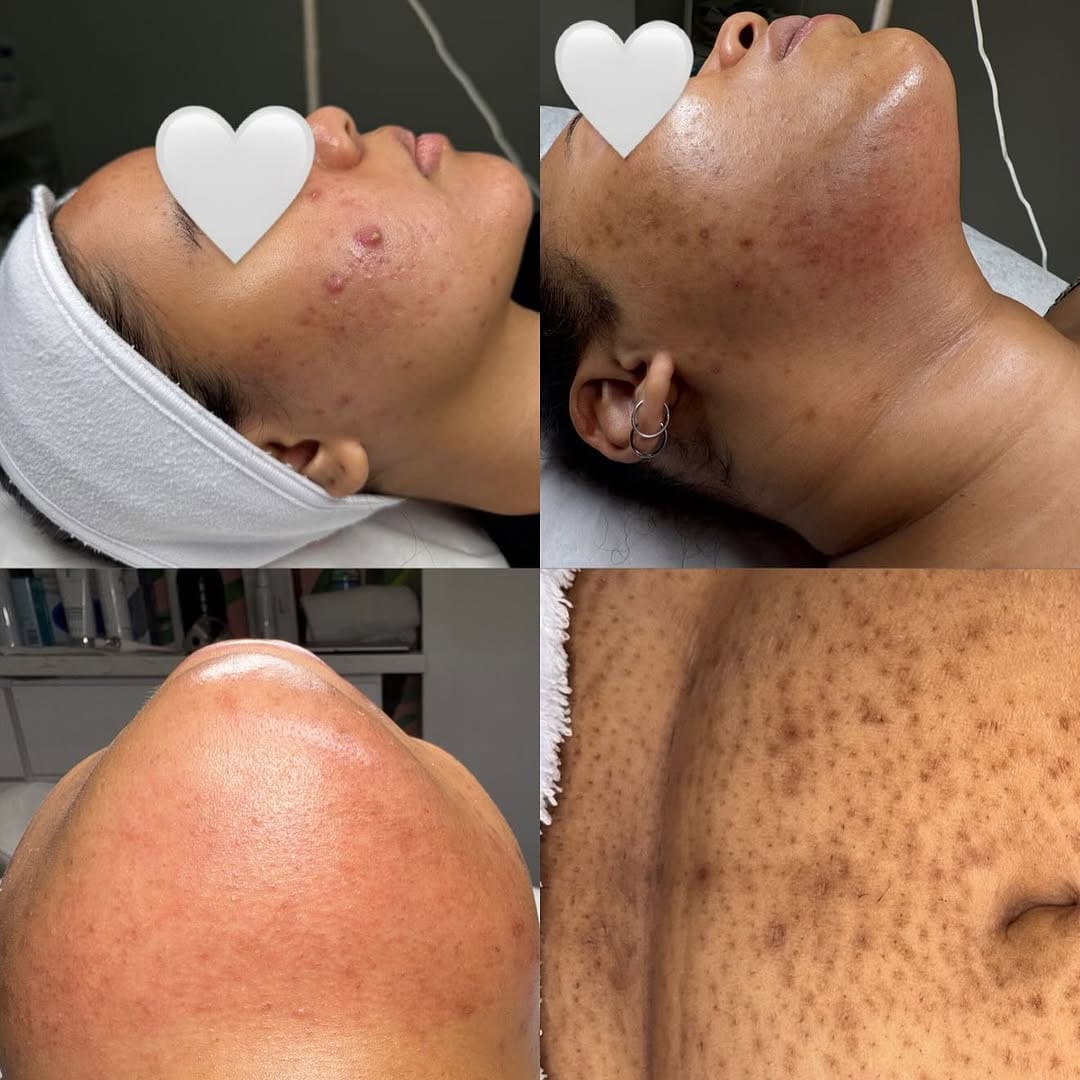 Post 9 by GTA CORRECTIVE SKIN SPECIALIST | HYDRAFACIAL PEELS MICRONEEDLING on Instagram (carousel)
