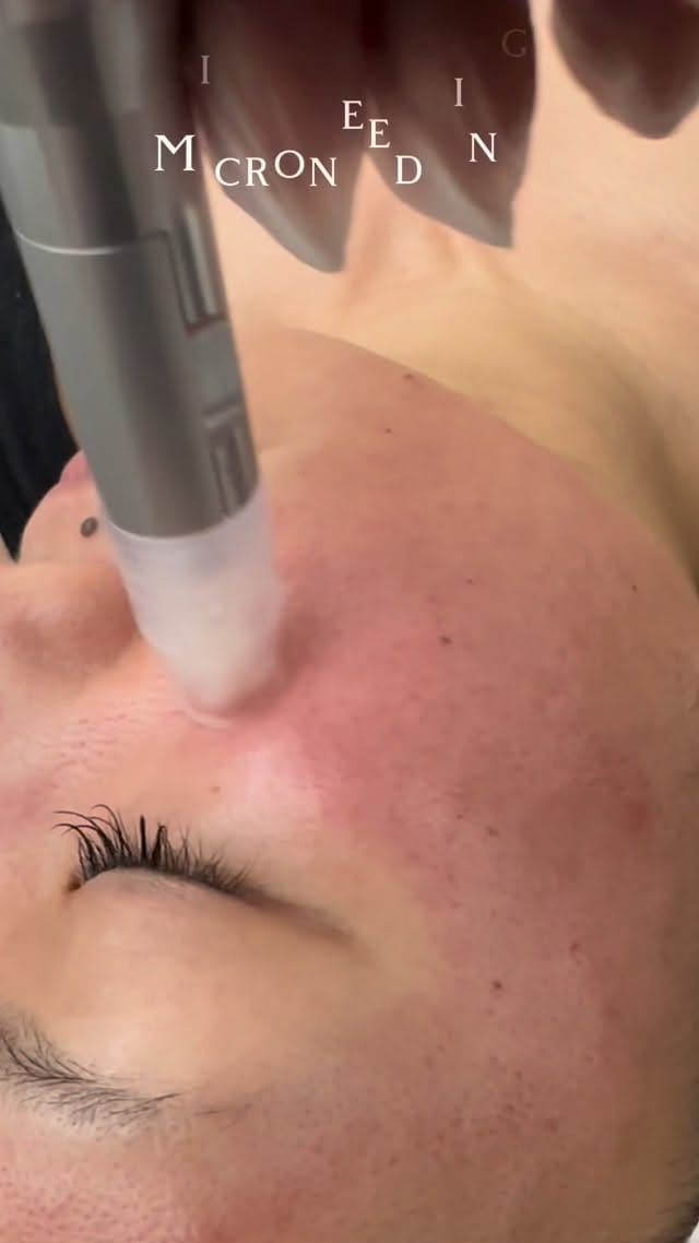 Post 7 by Advanced Skincare & Laser Hair Removal | Surrey Langley BC on Instagram (video)