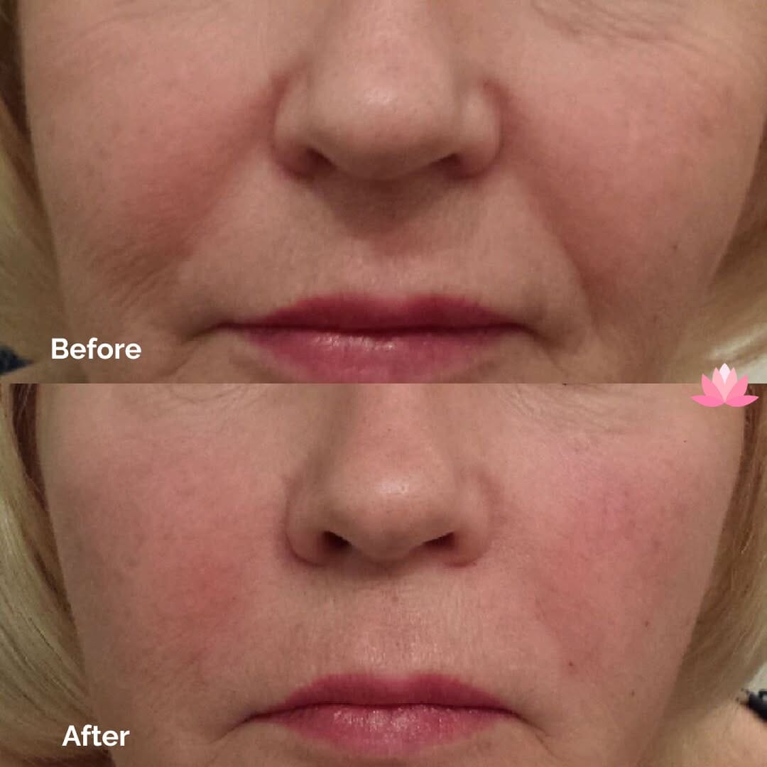 Post 7 by Fresh Cosmetic | Toronto Botox | Toronto Dermal Filler on Instagram (image)