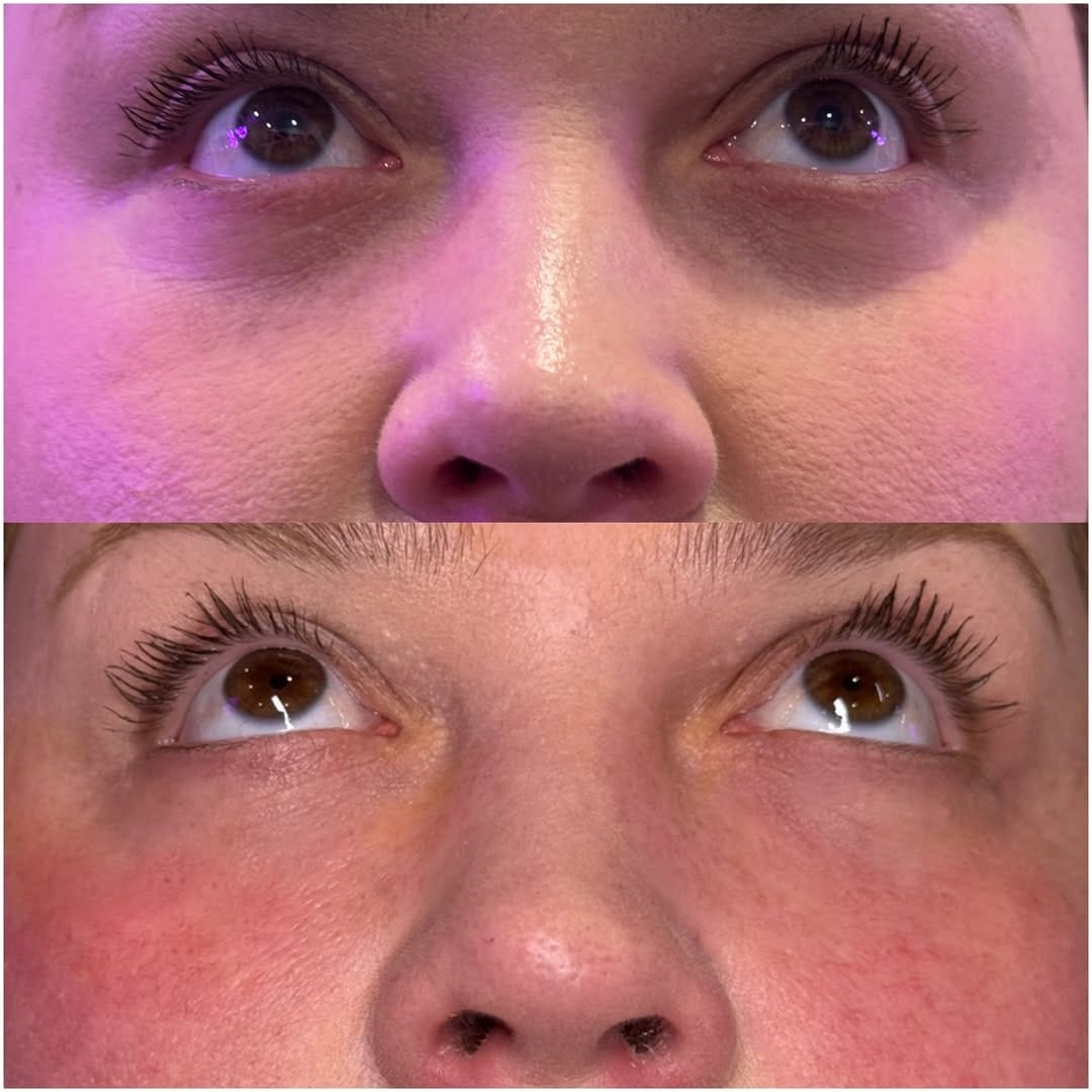 Post 5 by Fresh Cosmetic | Toronto Botox | Toronto Dermal Filler on Instagram (image)