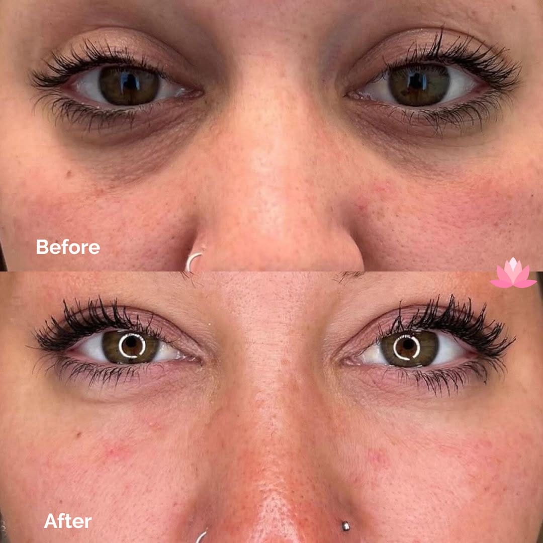 Post 8 by Fresh Cosmetic | Toronto Botox | Toronto Dermal Filler on Instagram (image)