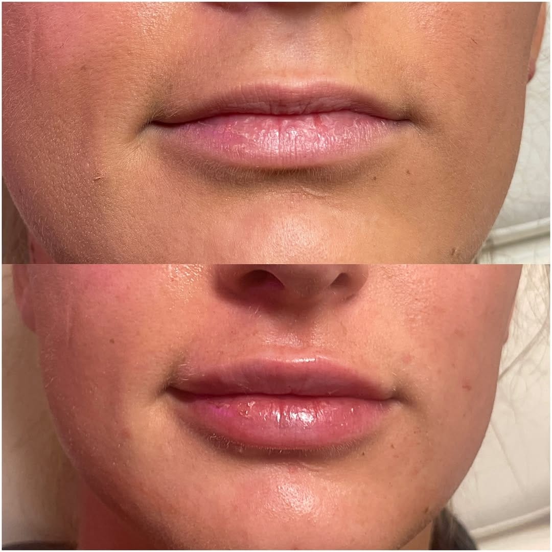 Post 4 by Fresh Cosmetic | Toronto Botox | Toronto Dermal Filler on Instagram (image)