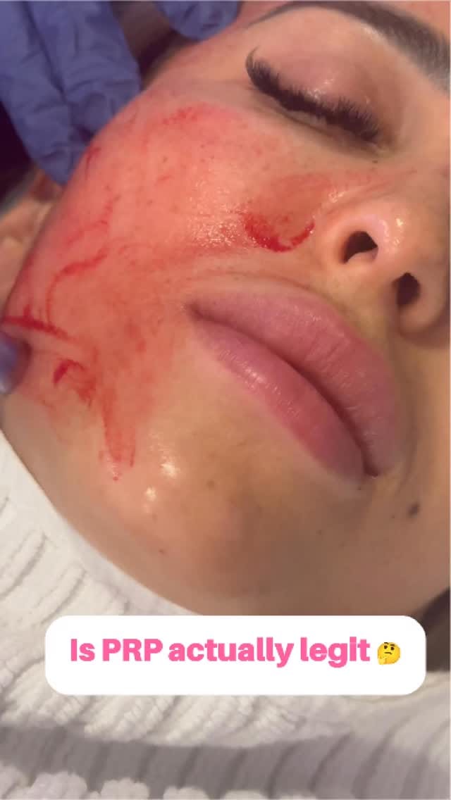 Post 9 by Fresh Cosmetic | Toronto Botox | Toronto Dermal Filler on Instagram (video)