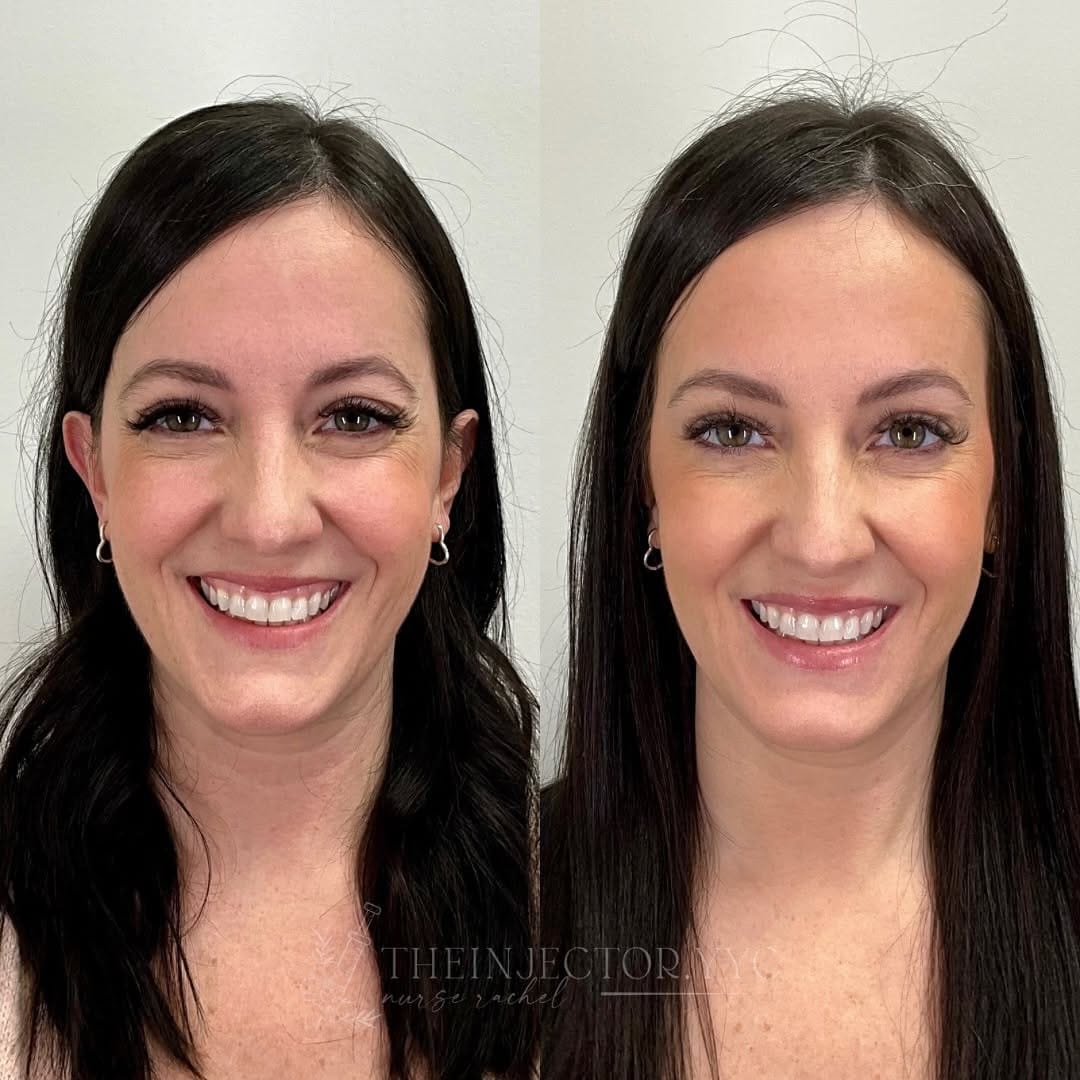 Post 8 by Rachel | Calgary Nurse Injector | Botox Filler YYC on Instagram (carousel)