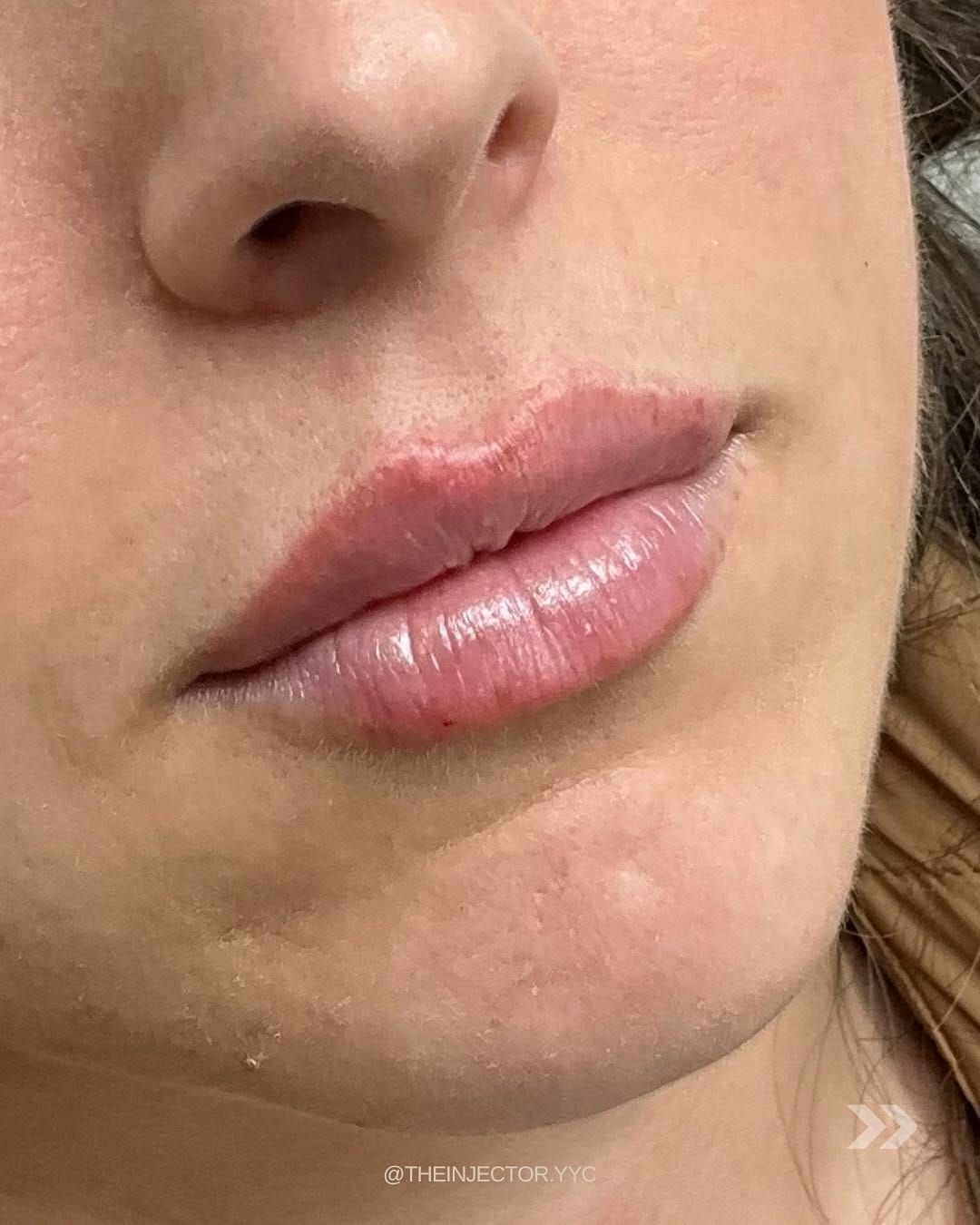 Post 6 by Rachel | Calgary Nurse Injector | Botox Filler YYC on Instagram (carousel)