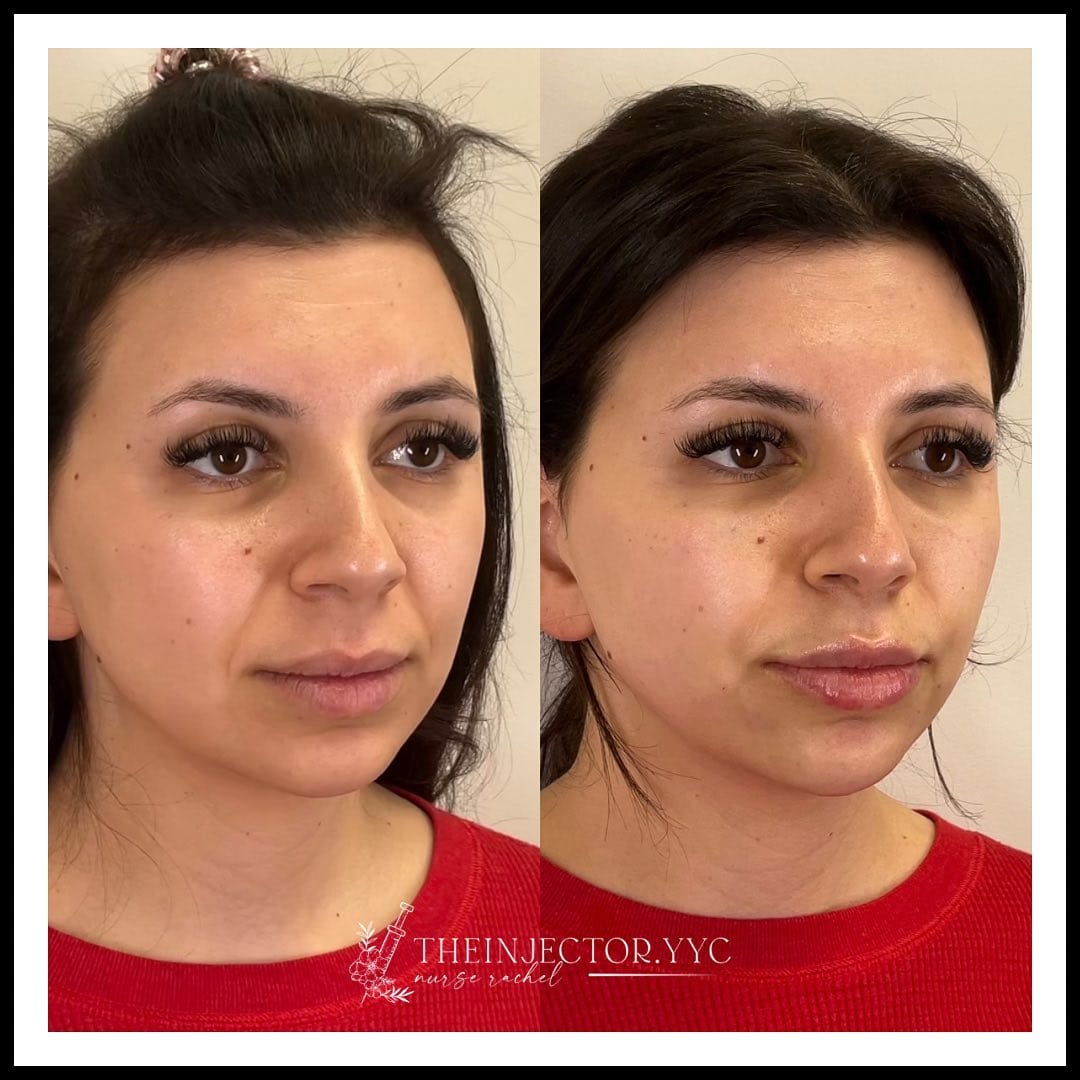 Post 10 by Rachel | Calgary Nurse Injector | Botox Filler YYC on Instagram (image)
