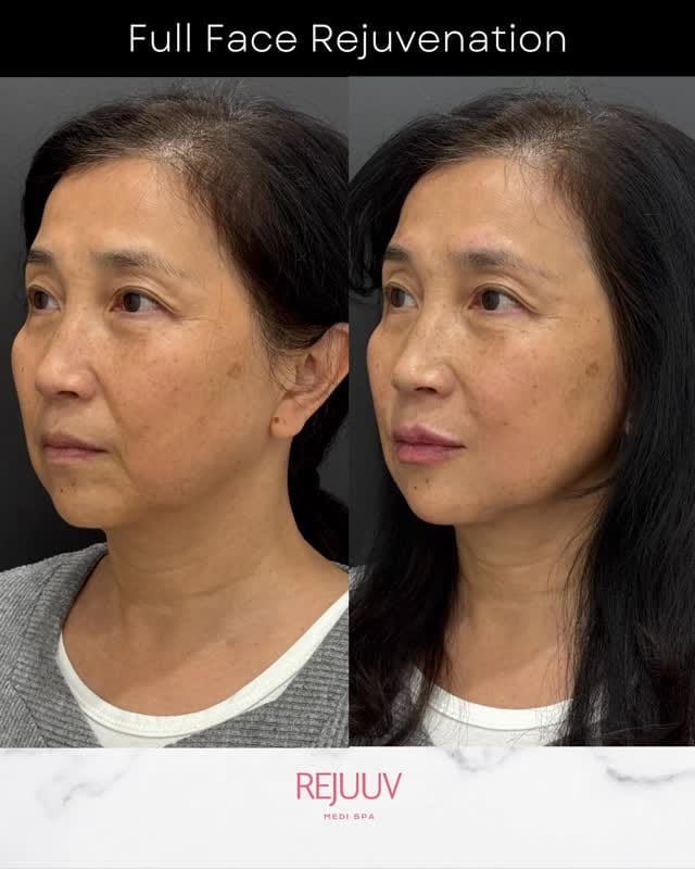 Post 10 by Rejuuv Medi Spa on Instagram (video)
