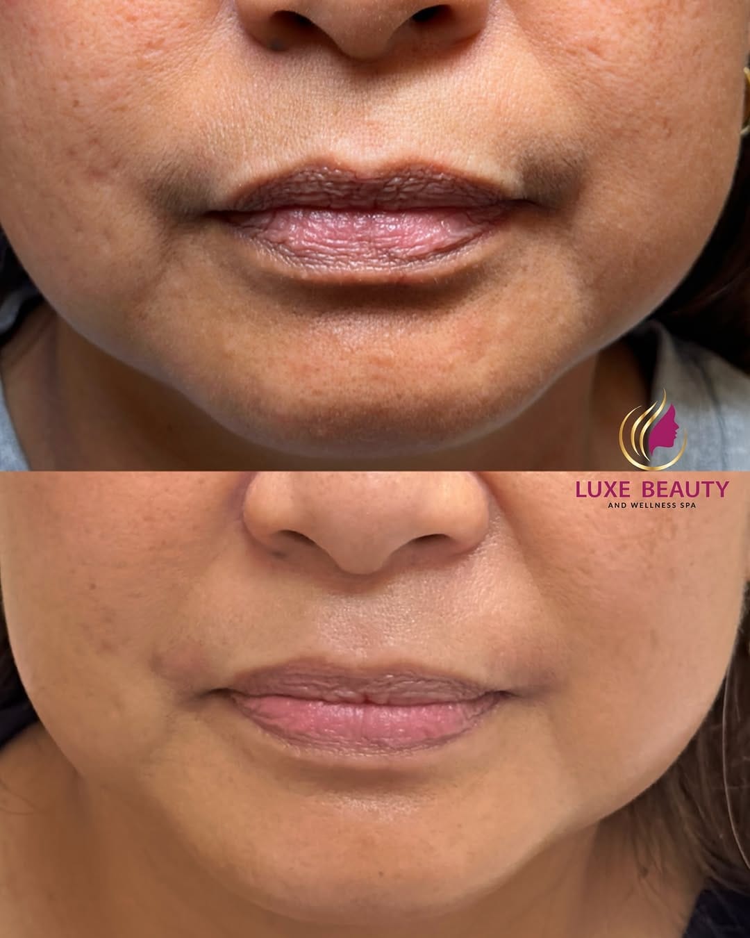 Post 5 by KATHRYN Aerolase Hyperpigmentation Expert GTA on Instagram (carousel)