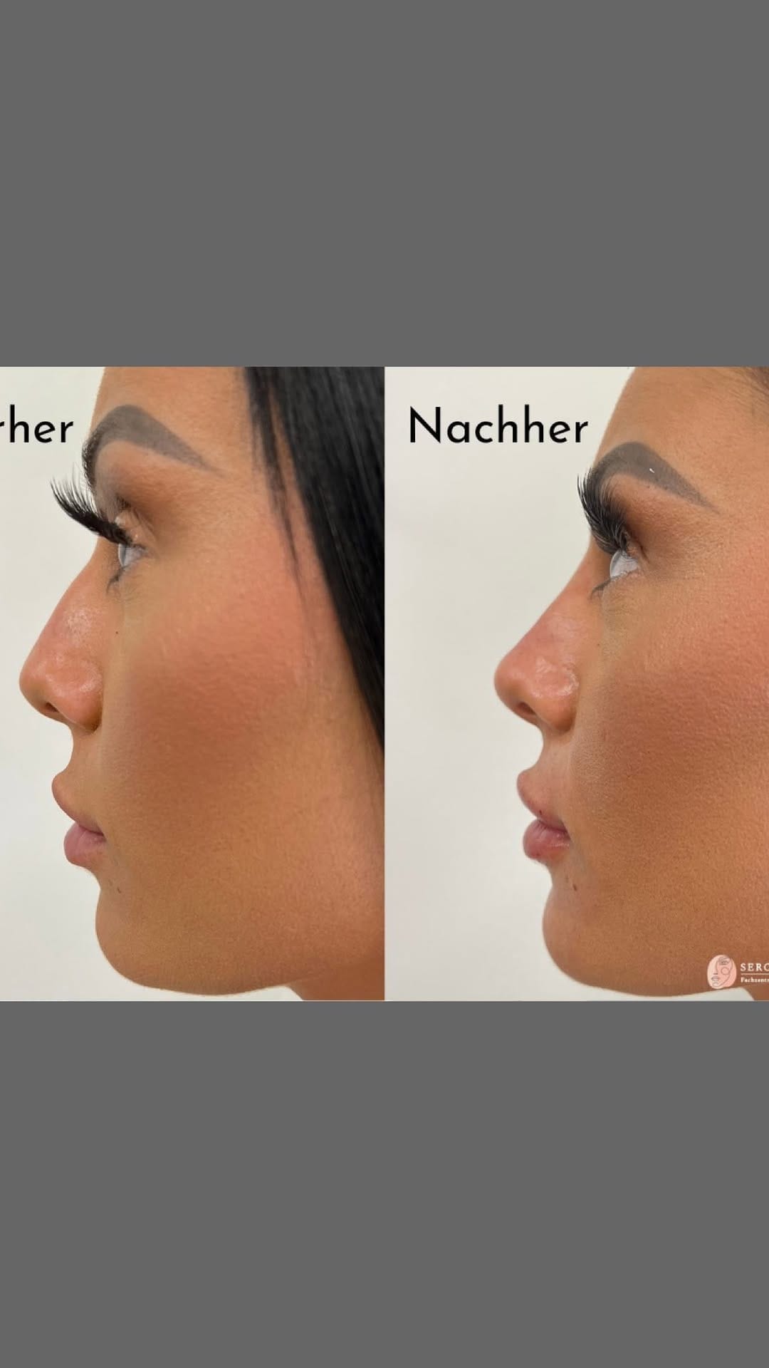 Post 10 by AESTHETIC CLINIC - DR. MED. SERCAN on Instagram (video)