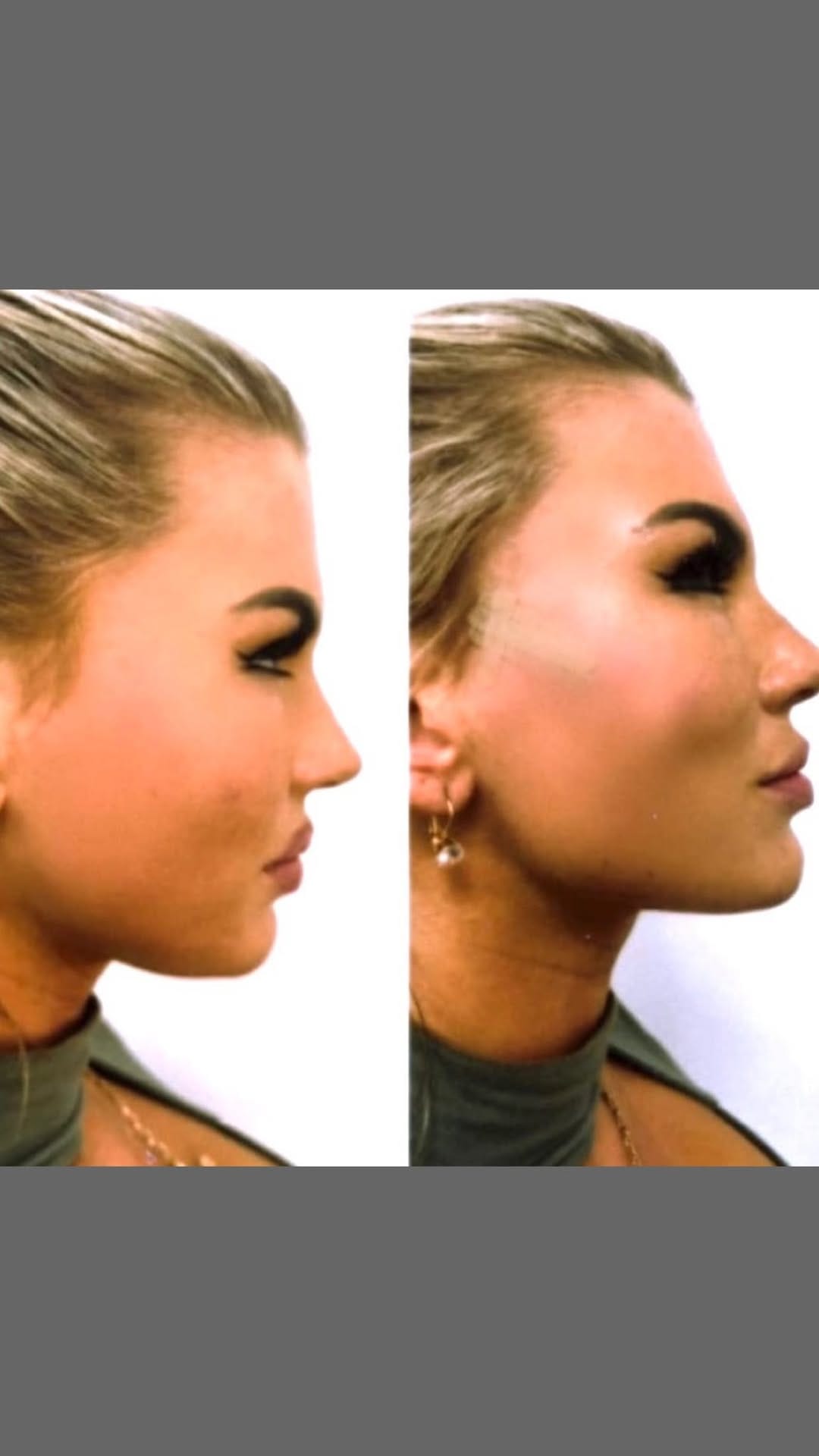 Post 9 by AESTHETIC CLINIC - DR. MED. SERCAN on Instagram (video)
