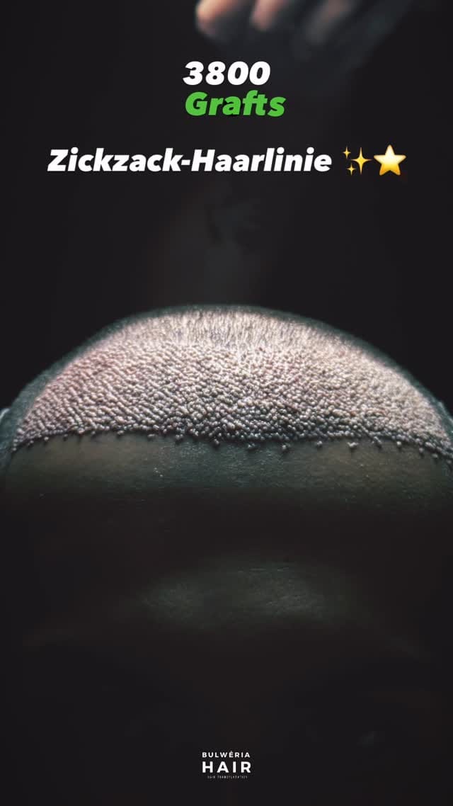 Post 2 by BULWÉRIA HAIR - HAARTRANSPLANTATION on Instagram (video)