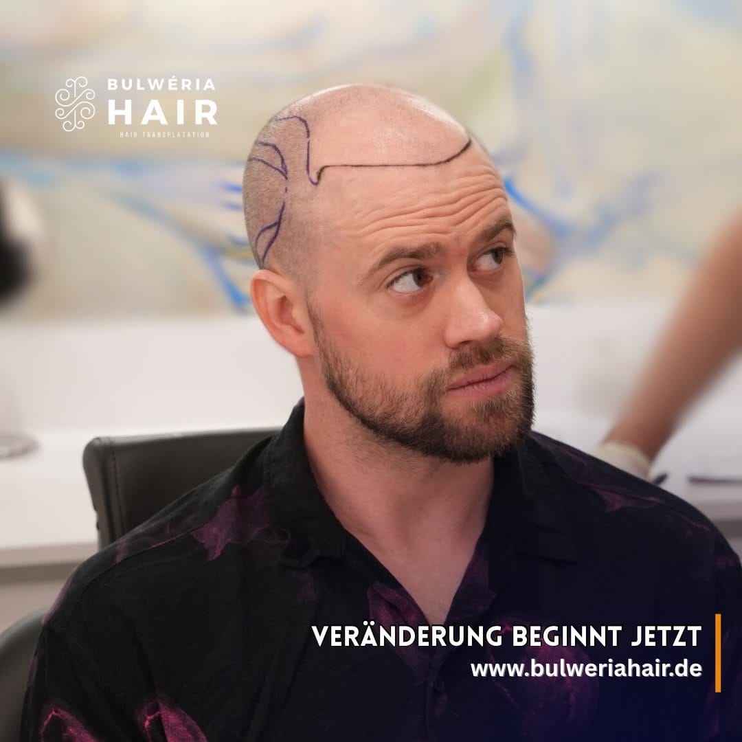 Post 6 by BULWÉRIA HAIR - HAARTRANSPLANTATION on Instagram (image)
