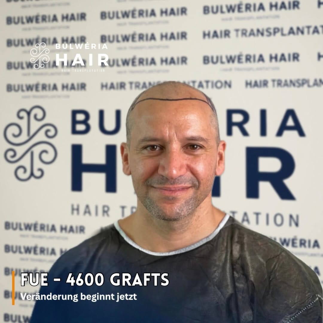 Post 9 by BULWÉRIA HAIR - HAARTRANSPLANTATION on Instagram (image)