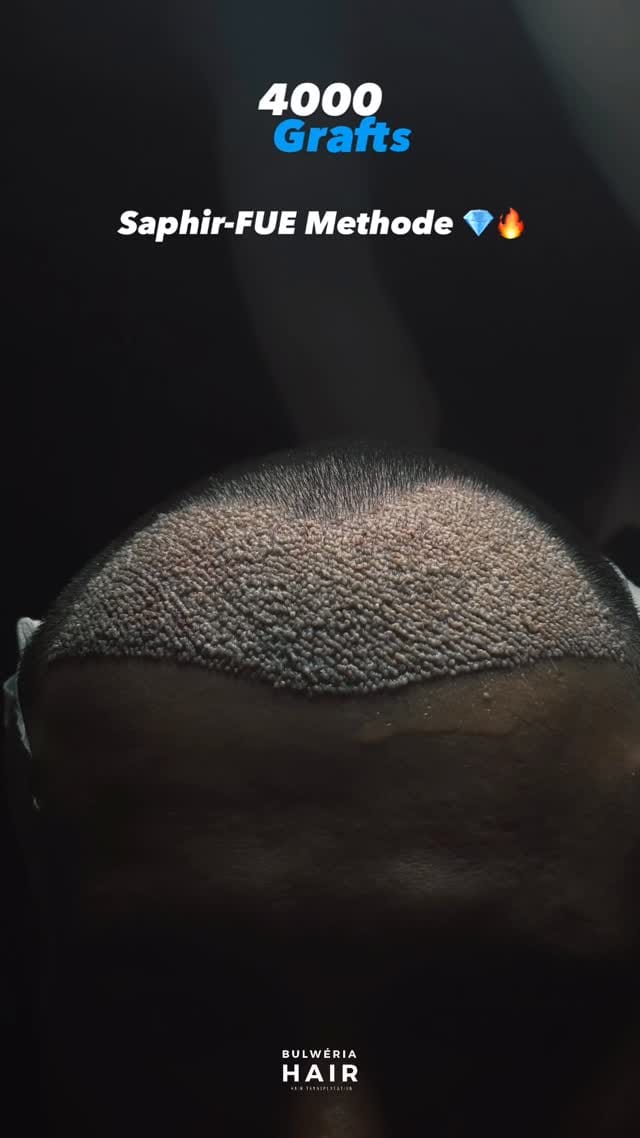 Post 5 by BULWÉRIA HAIR - HAARTRANSPLANTATION on Instagram (video)