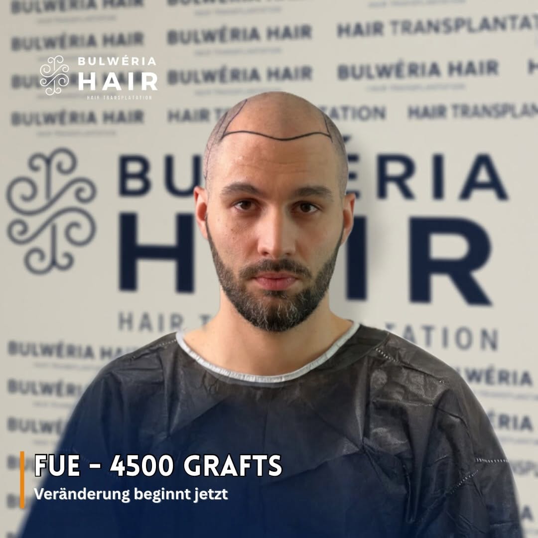 Post 3 by BULWÉRIA HAIR - HAARTRANSPLANTATION on Instagram (image)