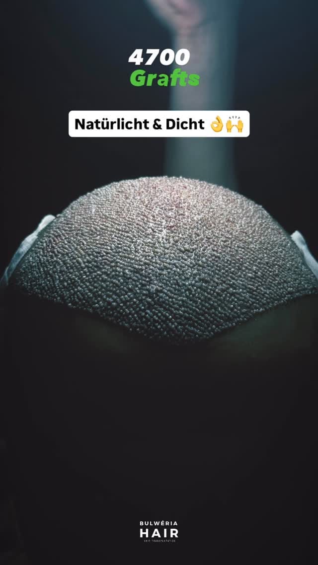 Post 8 by BULWÉRIA HAIR - HAARTRANSPLANTATION on Instagram (video)