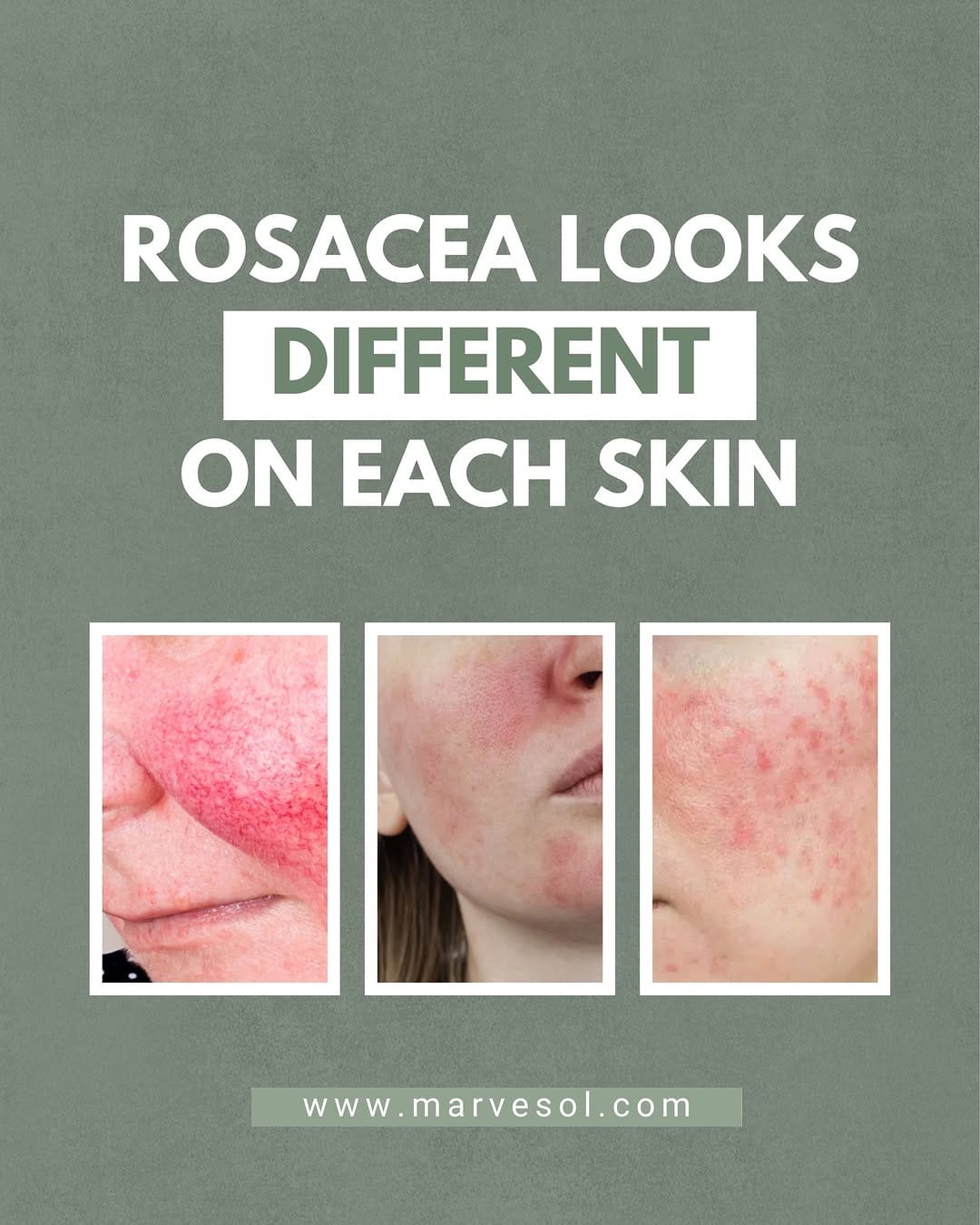 Post 9 by Rosacea Skincare Products on Instagram (image)