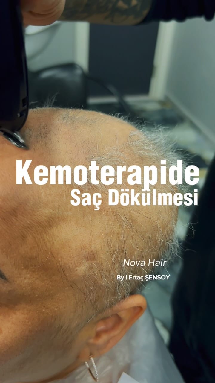 Post 5 by Nova Hair (By Ertaç ŞENSOY) on Instagram (video)