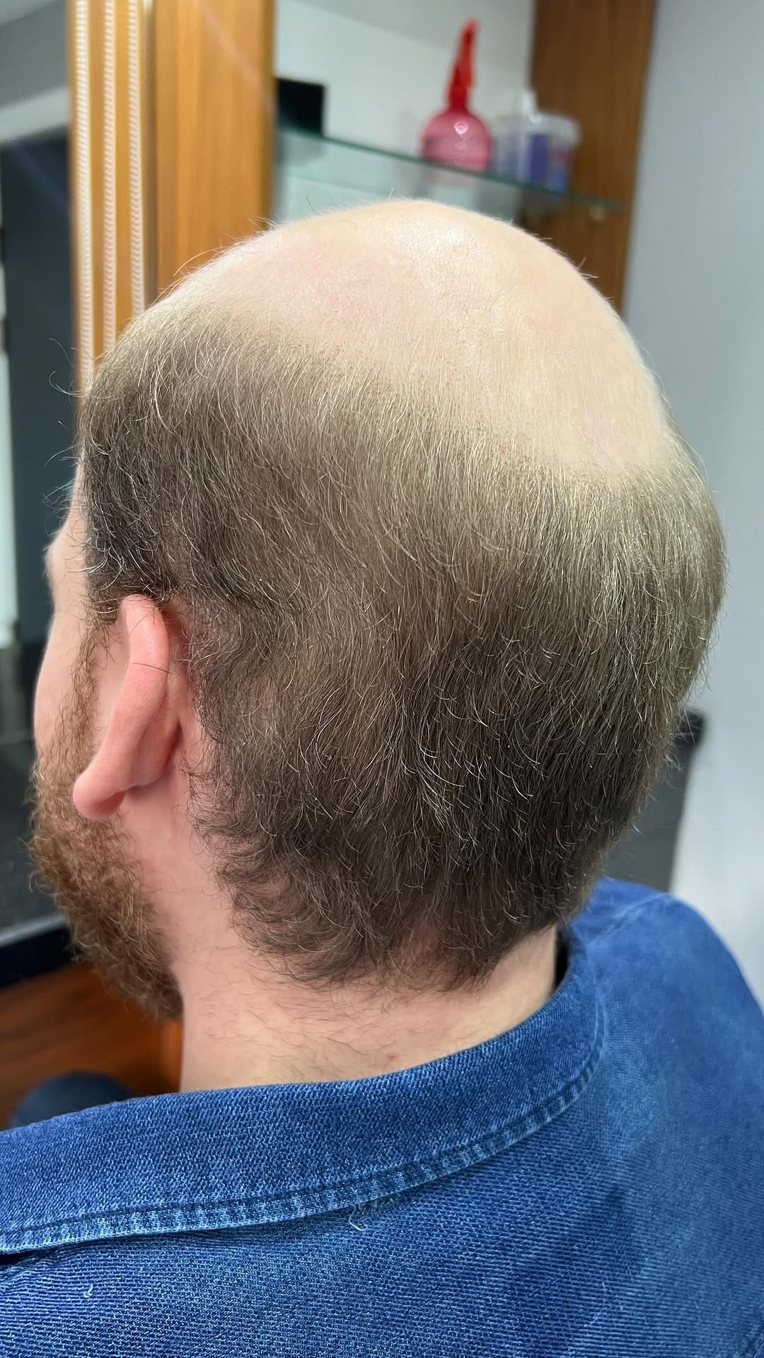 Post 1 by Nova Hair (By Ertaç ŞENSOY) on Instagram (video)