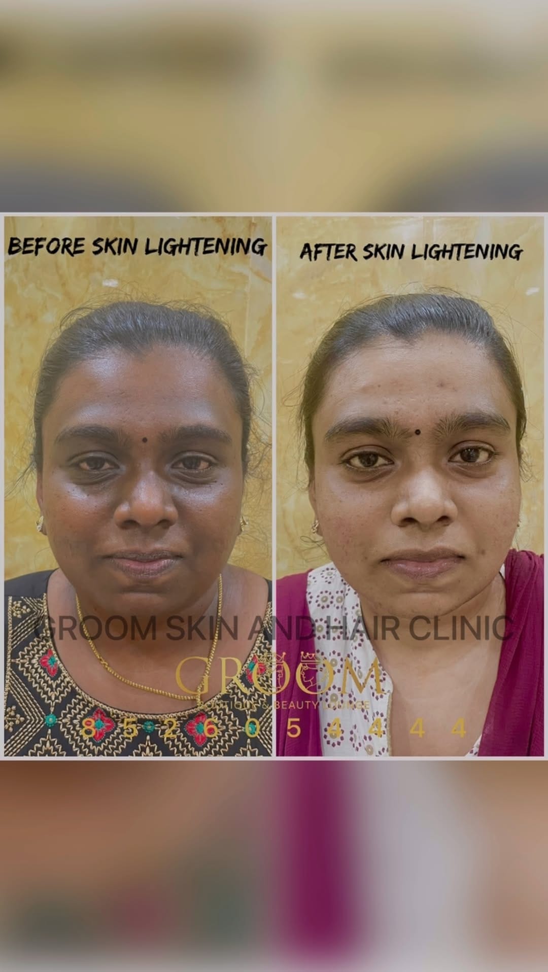 Post 10 by Groom Skin & Hair Clinic on Instagram (video)