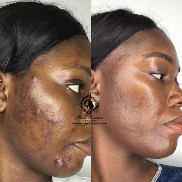 Post 2 by Glowessence Skincare on Instagram (video)