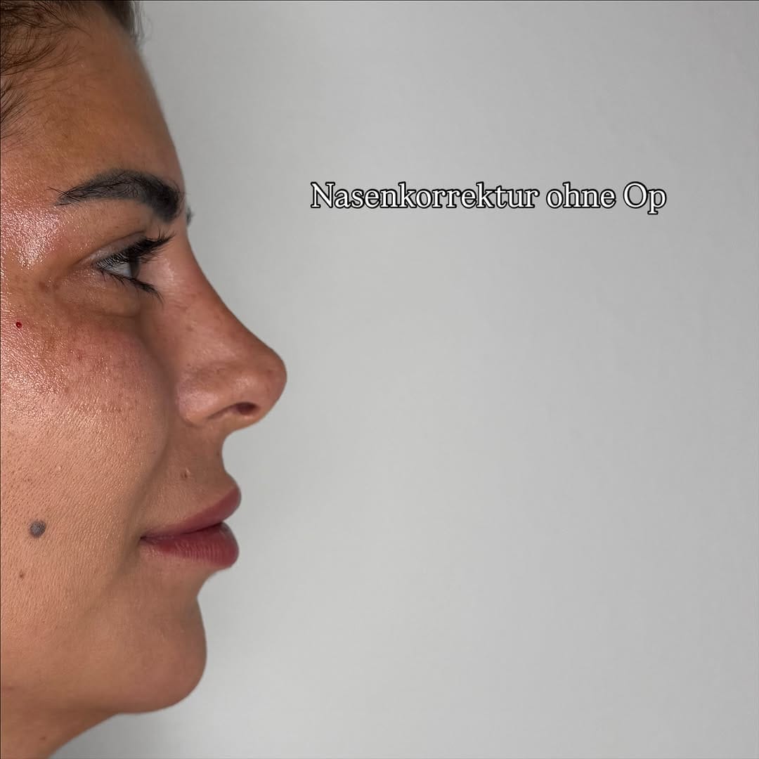 Post 10 by Berybeauty Aesthetics® - YOUR BEAUTY & FILLER EXPERTS on Instagram (image)