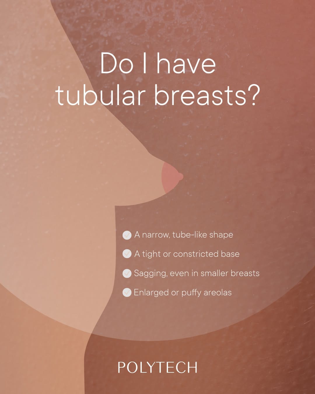 Post 3 by POLYTECH Breast Implants on Instagram (image)