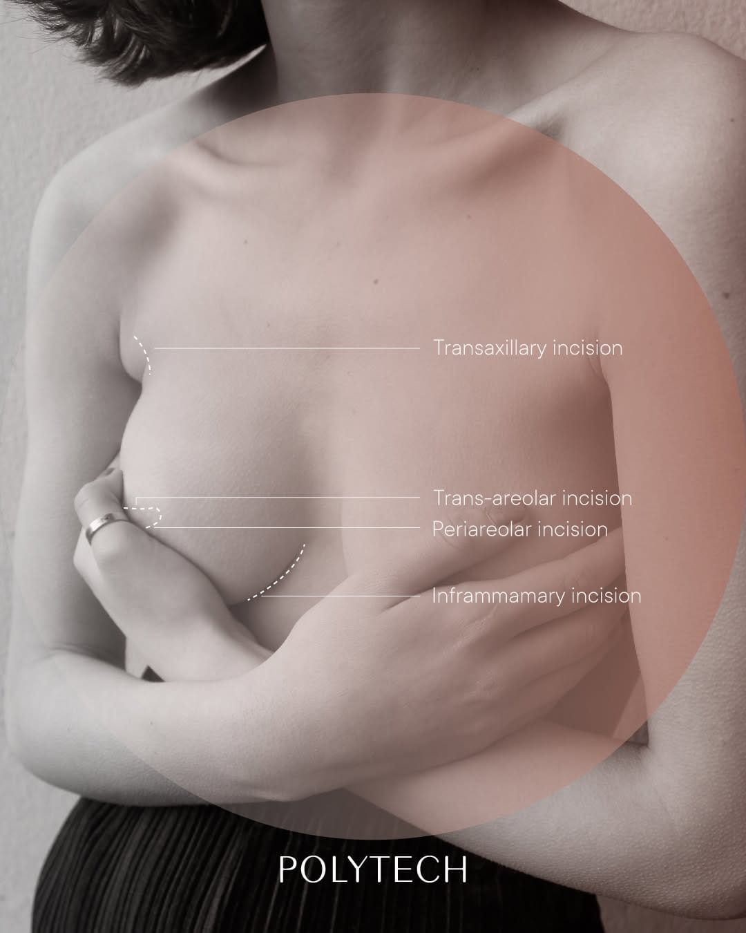 Post 4 by POLYTECH Breast Implants on Instagram (image)