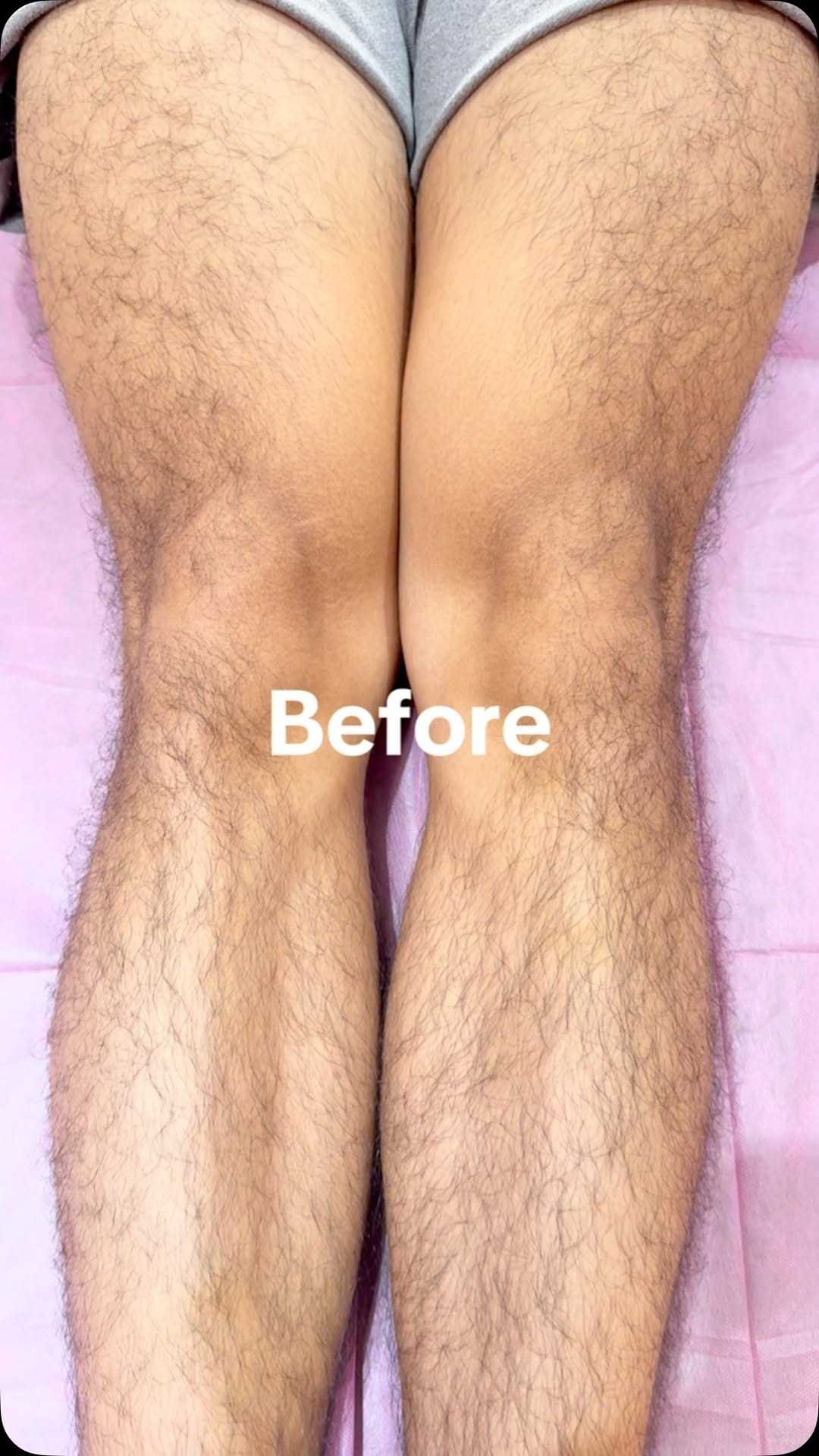 Post 9 by Body Beautiful Services. Top Hair Removal in Manila on Instagram (video)