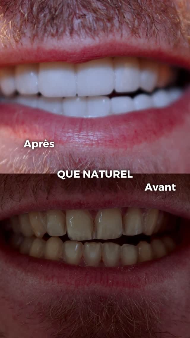 Post 4 by Facette dentaire à Dubai - Dentasmart.fr on Instagram (video)