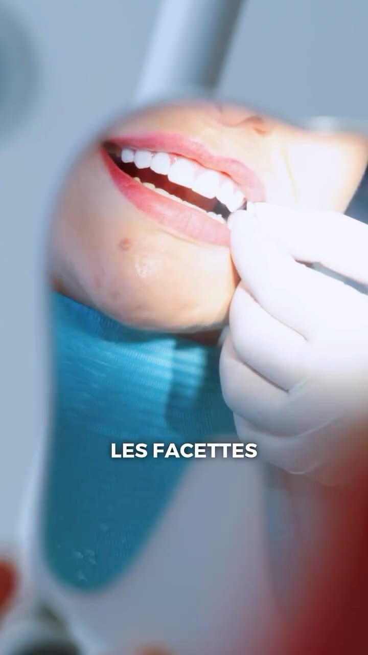 Post 7 by Facette dentaire à Dubai - Dentasmart.fr on Instagram (video)