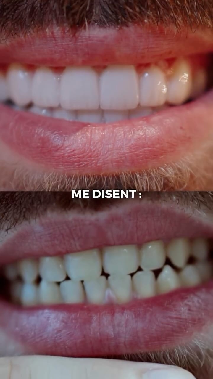 Post 6 by Facette dentaire à Dubai - Dentasmart.fr on Instagram (video)