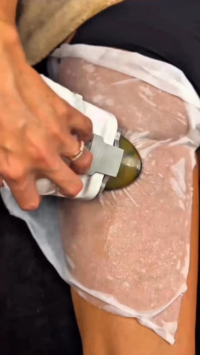 Post 3 by Lovely Minceur - Renata Franca - Accent Prime - Laser Soprano on Instagram (video)