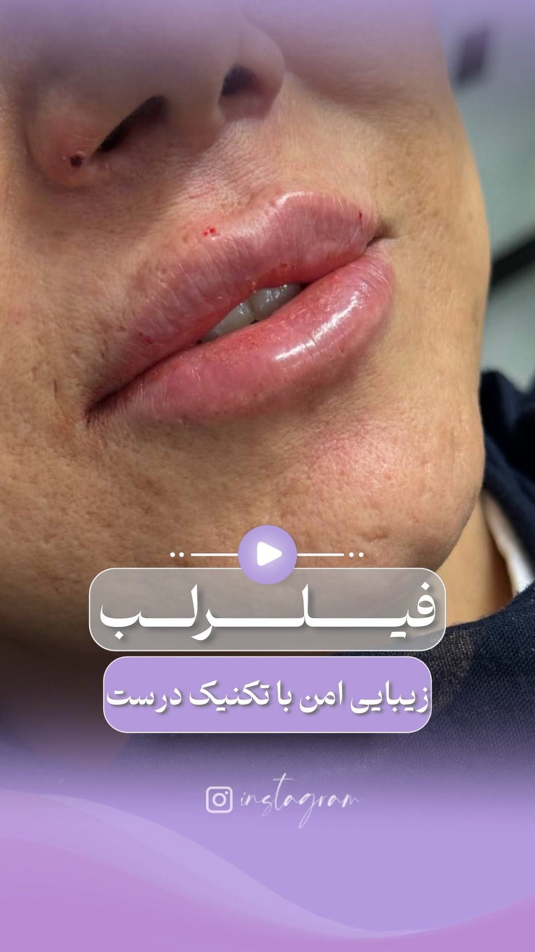Post 1 by 💜کلینیک عطرا💜 on Instagram (video)