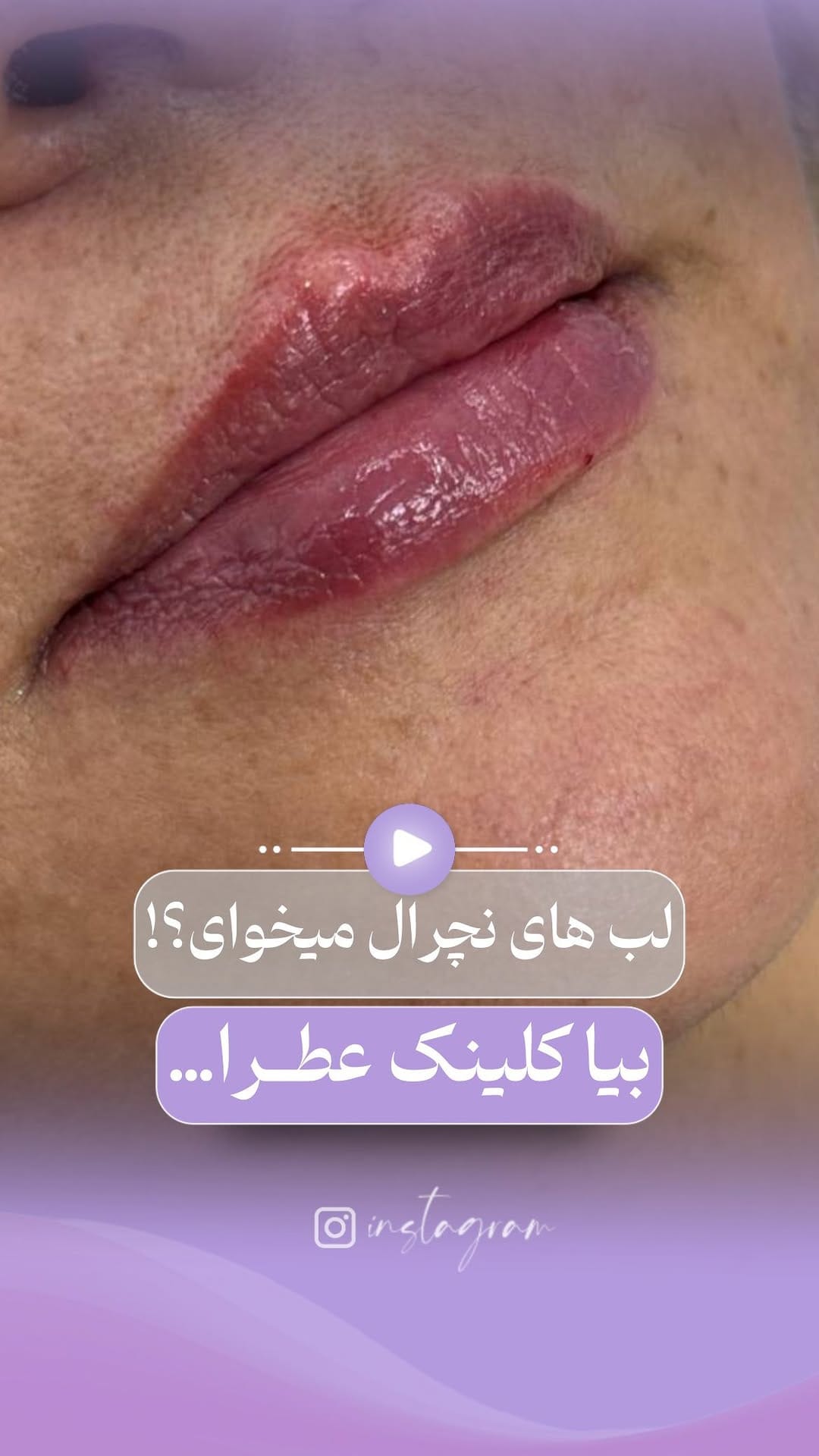 Post 7 by 💜کلینیک عطرا💜 on Instagram (video)