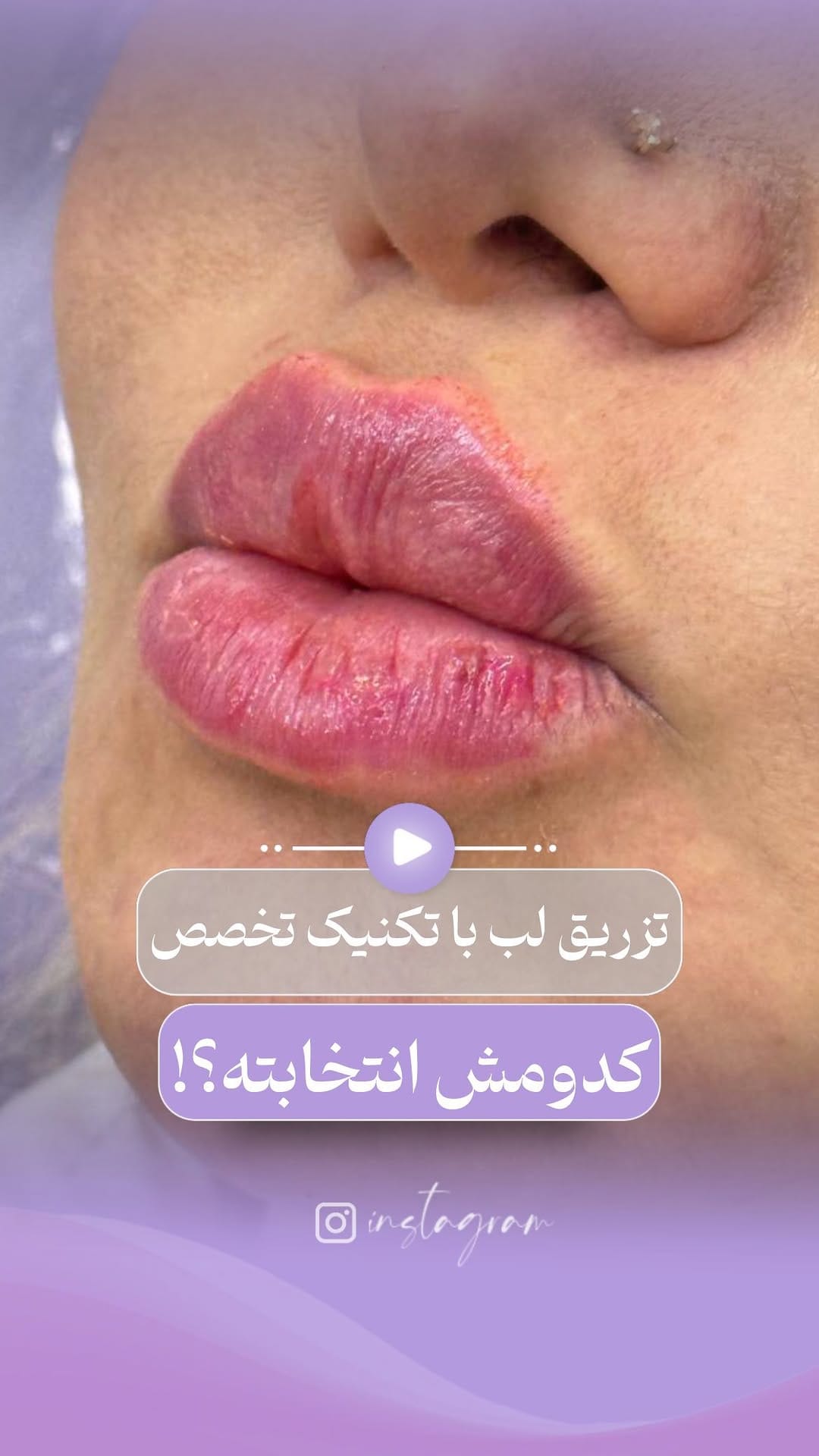 Post 8 by 💜کلینیک عطرا💜 on Instagram (video)