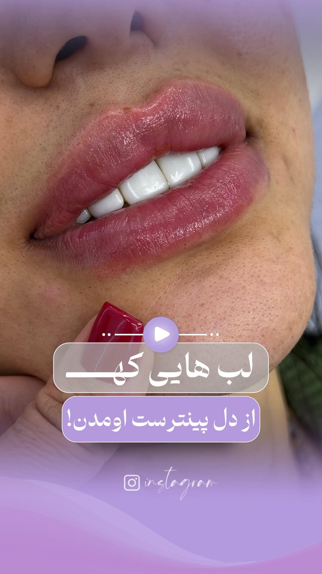 Post 5 by 💜کلینیک عطرا💜 on Instagram (video)