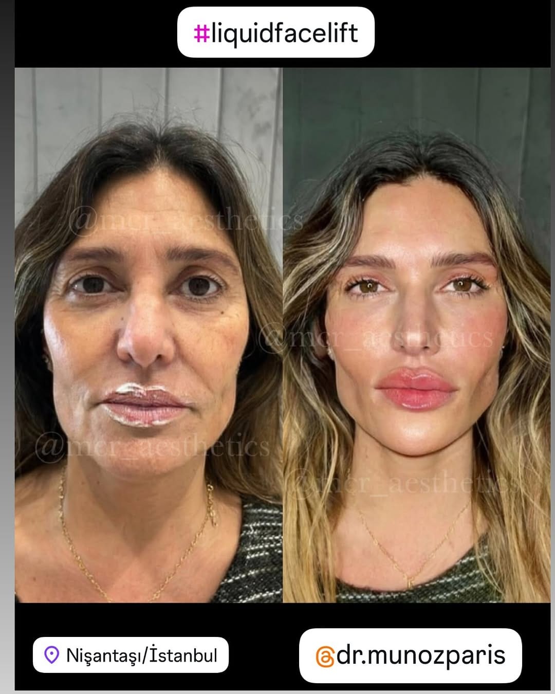 Post 4 by Aesthetic and Antiaging Clinic, Istanbul on Instagram (image)