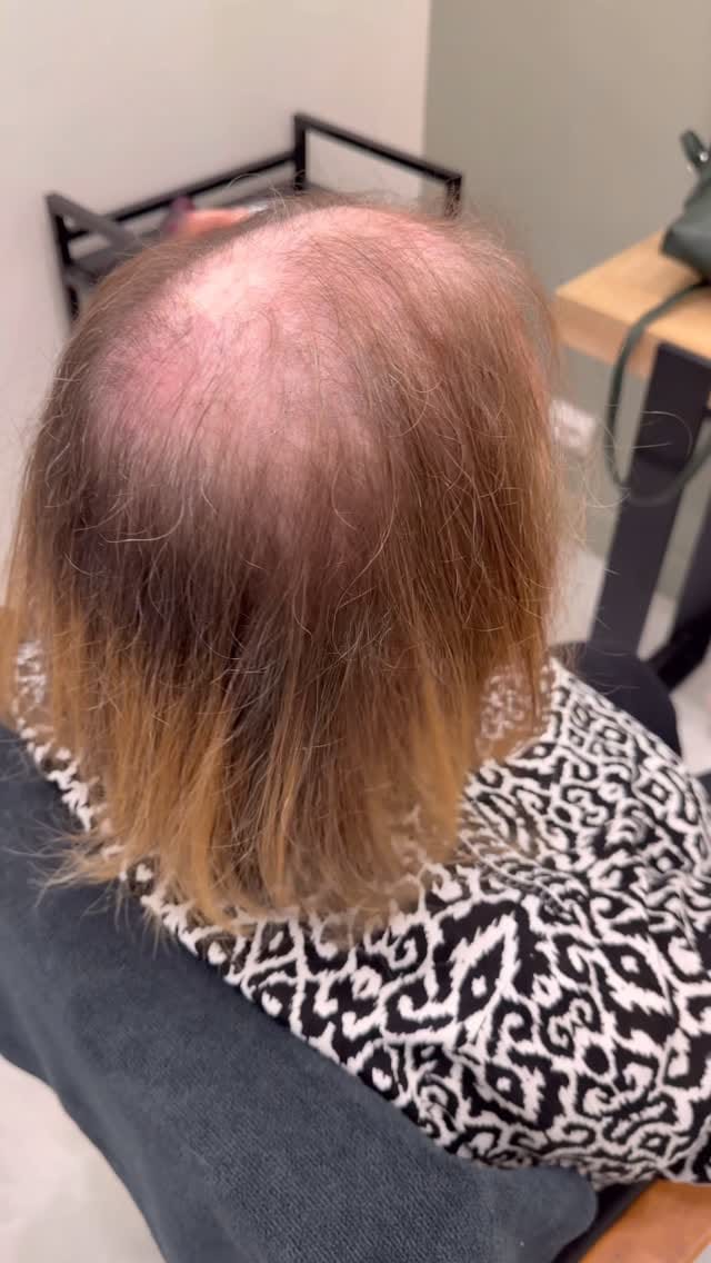 Post 1 by ChristenB alopecie,calvitie on Instagram (video)