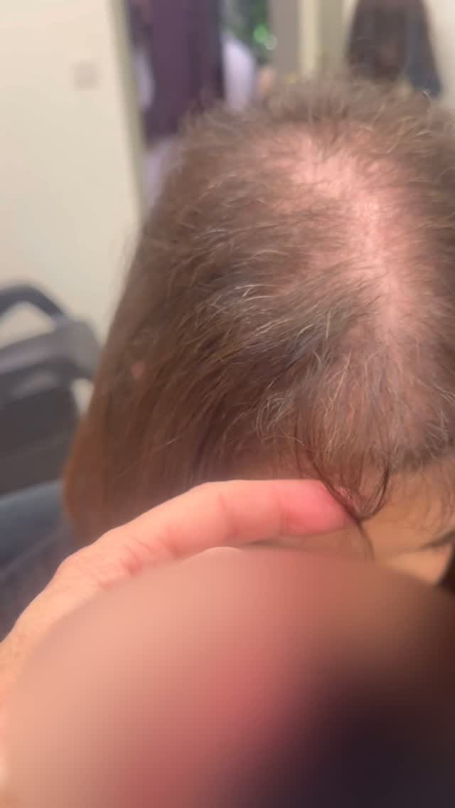 Post 9 by ChristenB alopecie,calvitie on Instagram (video)