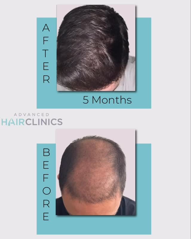 Post 6 by Advanced Hair Clinics on Instagram (video)