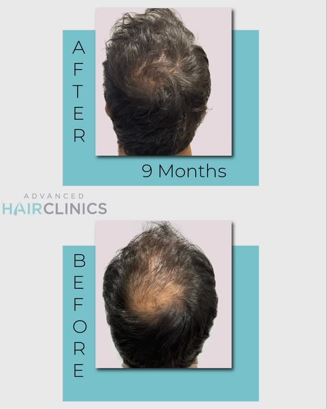 Post 8 by Advanced Hair Clinics on Instagram (video)